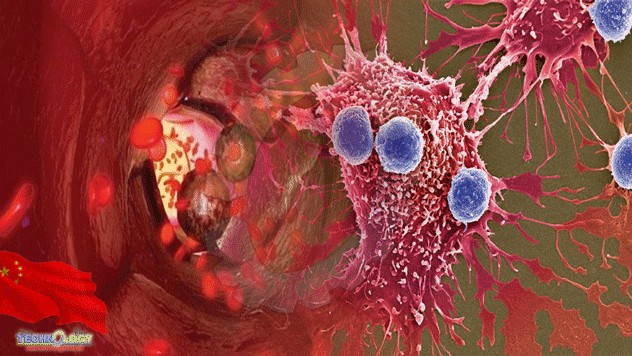 Phát hiện 'thủ phạm' khiến tế bào ung thư di căn