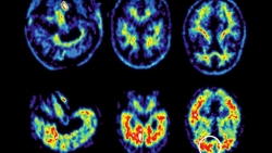 Phụ nữ lớn tuổi có nguy cơ mắc bệnh Alzheimer cao hơn